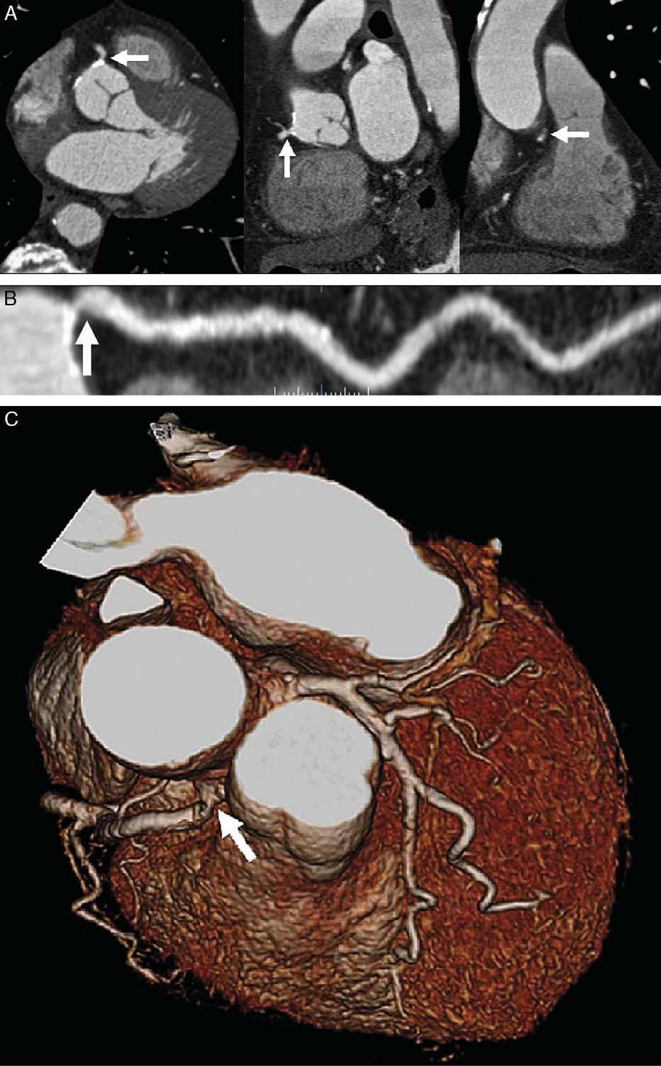 Kerl et al J Thorac Imaging Volume 22, Number 1, February 2007 FIGURE 9. Contrast enhanced, retrospectively ECG-gated dual-source CTA in a 72 year old woman with atypical chest pain.