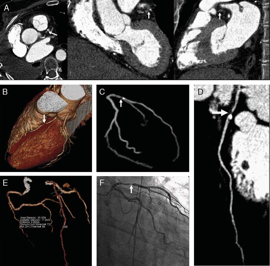 J Thorac Imaging Volume 22, Number 1, February 2007 FIGURE 10. Contrast enhanced, retrospectively ECG-gated 64-slice coronary CTA in a 59-year-old man with atypical chest pain.