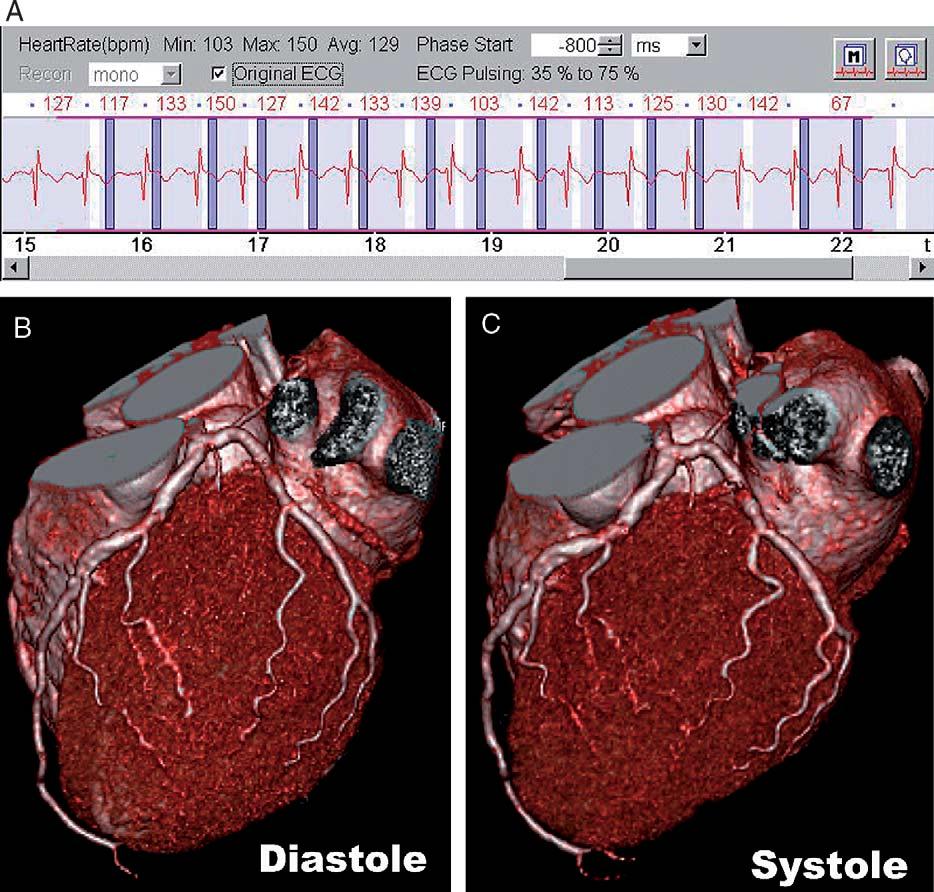 J Thorac Imaging Volume 22, Number 1, February 2007 Rate Control Rate Control for Improving Image Quality For a variety of reasons, slow heart rates are highly desirable for cardiac CT using 4-slice