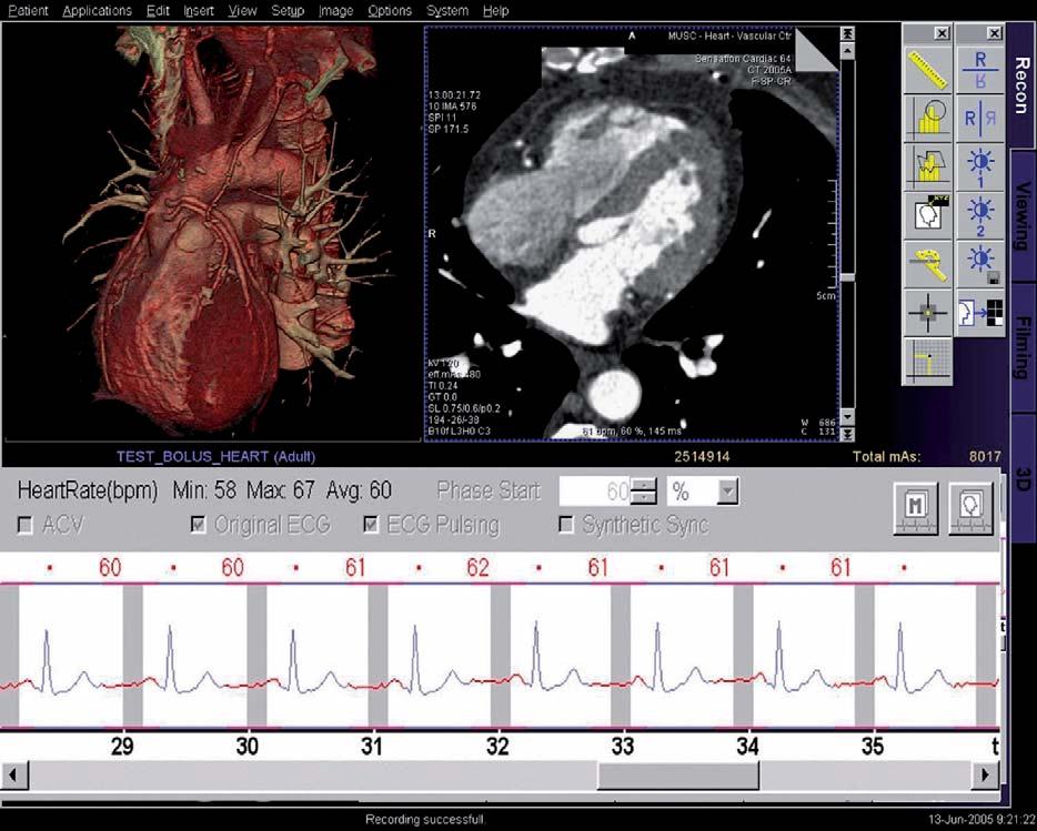 Kerl et al J Thorac Imaging Volume 22, Number 1, February 2007 during the particular phase of the cardiac cycle at which images are most likely to be reconstructed.