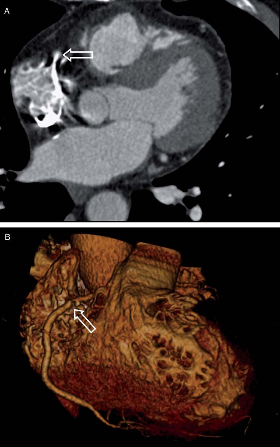 J Thorac Imaging Volume 22, Number 1, February 2007 FIGURE 4. Contrast enhanced, retrospectively ECG-gated CT coronary angiography without saline chasing technique.