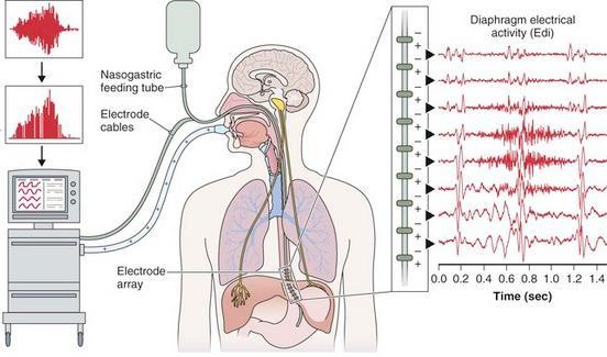 1. A monitor of electrical diaphragmatic activity (Edi) 2.