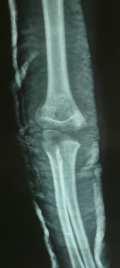 H.K. Gupta, Results of lateral pin fixation for the displaced supracondylar fracture of humerus in children Results 25 cases of displaced Supracondylar fracture (type III) were treated with lateral