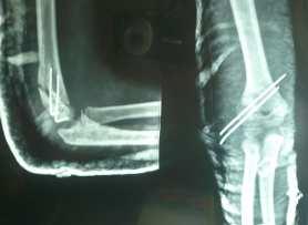 Journal of College of Medical Sciences-Nepal, 2012, Vol-8, No-1 Fig-2: Post operative x-ray of the fracture supracondylar of the humerus infection was also in only two cases, consistent with findings