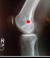7% (Shah 2012) Patellar fracture ROM loss Increased pain/arthrosis (Tanaka 2012) 47% due to improper technique (Parikh 2013) Femoral