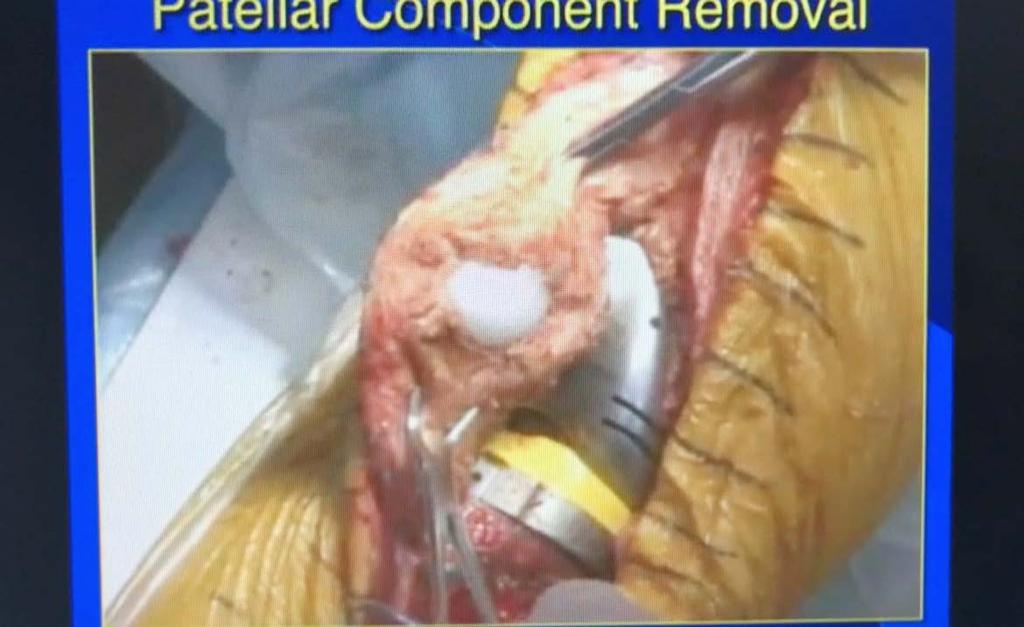 Phase 2 Removal Patella Usually not done in aseptic revision unless gross malposition https://www.vumedi.