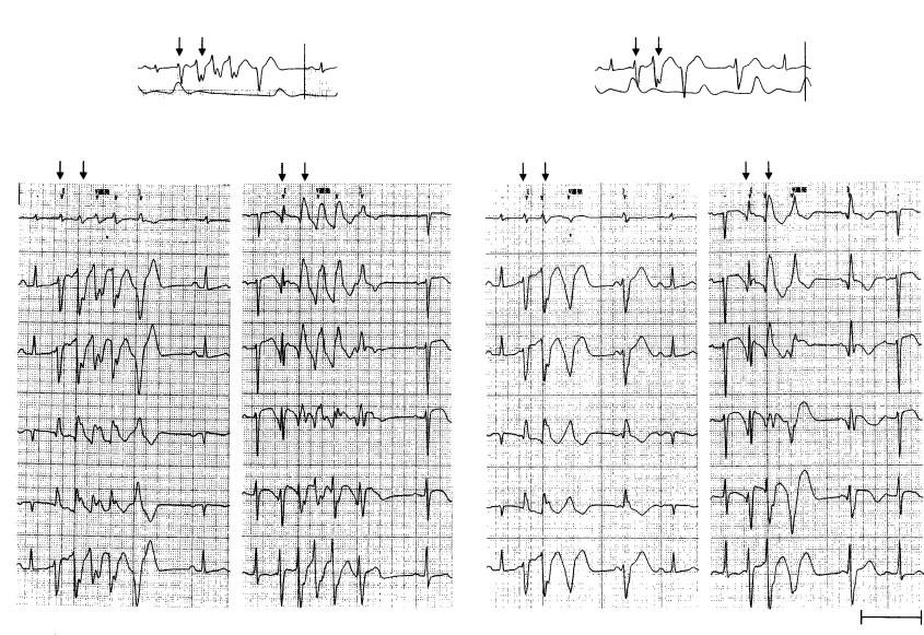 J Arrhythmia Vol 22 No 3 2006 namically unstable VT appeared several times, however. Although antiarrhythmic drugs including -blockers were administered, sufficient control of VT was not achieved.