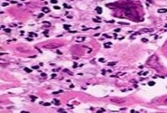 Figure - 15: Tzanck smear: Bullous impetigo acntholytic cells and plenty of neutrophils.