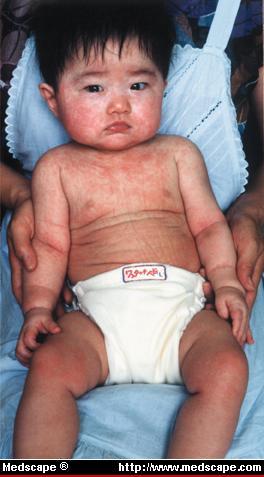 Roseola Infantum HHV 6 Common between 6 months and 3 years Sudden onset of fever followed by