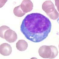 Diagnosis Peripheral smear: atypical lymphocytes Paul-Bunnel test. IF, PCR and viral culture.