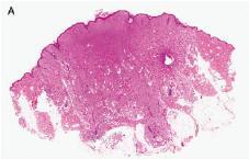 melanocytic and smooth muscle markers Group of mesenchymal neoplasms Angiomyolipoma Clear cell sugar tumor of the