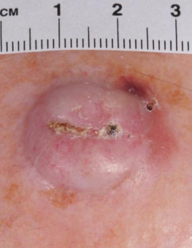 Pleomorphic Dermal Sarcoma -Clinical Features- Sun-damaged skin Head and neck; scalp Elderly Strong male
