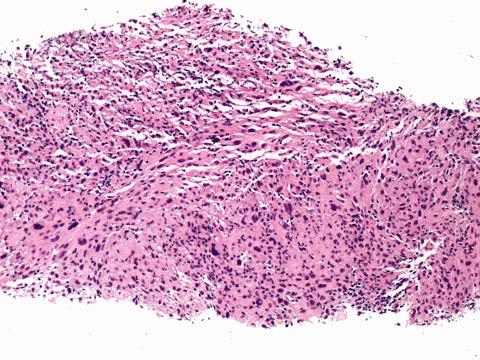 Pleomorphic Dermal Sarcoma -Prognosis- Presence of metastatic disease associated with