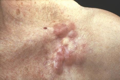 Dermatofibrosarcoma Protuberans Clinical Presentation Young adults (20-40 years) Trunk > head & neck and