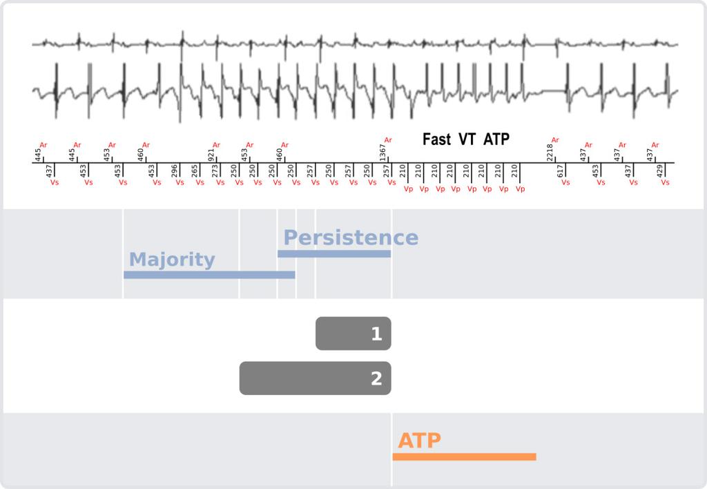 Example: Fast VT zone programmed from 210 bpm to 240 bpm (285 ms to 250 ms) Rate criteria is met: each of the last 4 cycles of the persistence is in the Fast VT zone (250 285 ms) and the average as