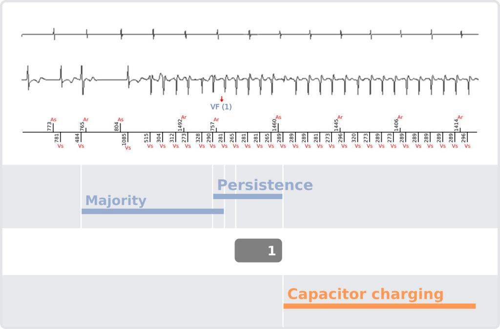 Shock When a rhythm has been classified as a ventricular fibrillation (VF) based on the Rate only or Rate + Stability criteria described above, the device starts charging the capacitors and then