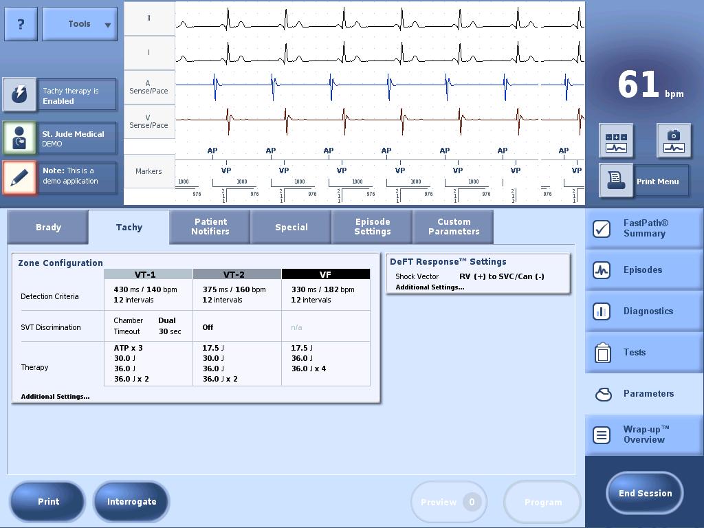 35 Detection 3 zone VF with VT-1 and VT-2 Tiered therapy with 2 tach zones and VF Arrhythmias in tach
