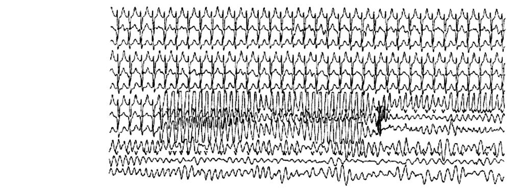 57-Year-Old Male with Palpitations and CAD No Prior History of Syncope 16:10:00-1 16:10:15-1 16:10:30-1