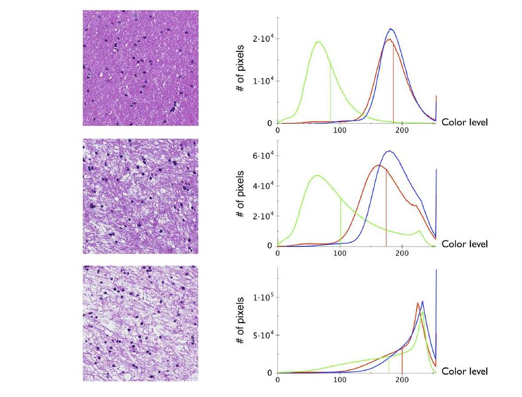 Quantification of edema Tumor tissue: normal cells +