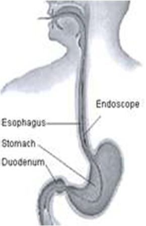 Upper Endoscopy (EGD) The EGD will provide important information about the inside of your GI tract for your bariatric surgeon who will be performing surgery on your stomach Prior to bariatric surgery