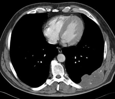 Case Part 1 57F w/ metastatic lung CA to chest wall - Opioid naive --> Morphine IR 7.