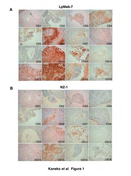 magnification: 100 (A, B); 200 (C, D). Scale bar: 100 µm. Fig. 4. Immunohistochemical analysis against metastatic osteosarcomas using three anti-podoplanin mabs.