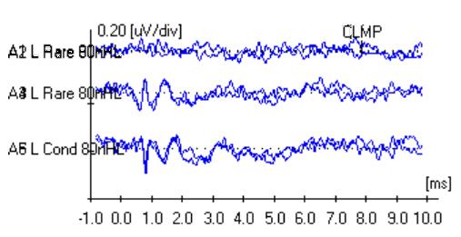Figure 2: A clear and large (about 0.8µV) CM in a case of a baby with ANSD. Top: Rarefaction click (two runs, superimposed). Centre: Condensation click (two runs, superimposed).