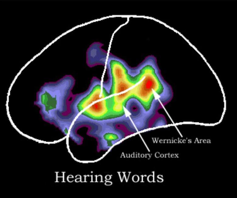 Discrimination of sound patterns by the 1& 2 auditory cortex.