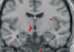 PET studies Hypothalamic gray matter ipsilateral to the side of pain