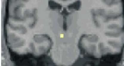 2004 MRI: voxel based morphometry The similar region has increased