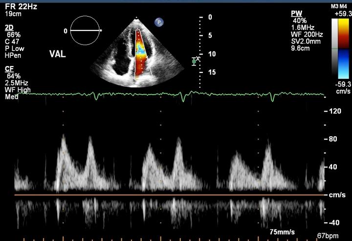 Maintain SV placement with decrease of 20 cm/s in peak MV E velocity unmasking an A wave +