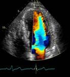 Diastolic Function Exam PW Doppler of Mitral valve Inflow Apical 4 chamber view Color flow imaging for optimal alignment SV size