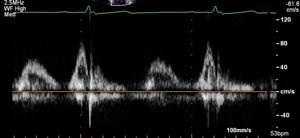 ) placed at or within 1 cm of mitral