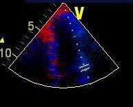 mitral stenosis, e increased with > 2+MR