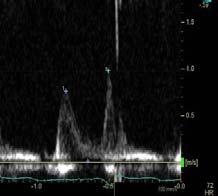 Diastolic Dysfunction in Patients with Normal