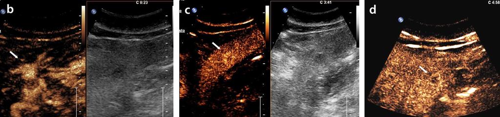 : 6b,6c,6d- At CEUS examination the lesion shows a marked contrast enhancement during the arterial phase (Fig.