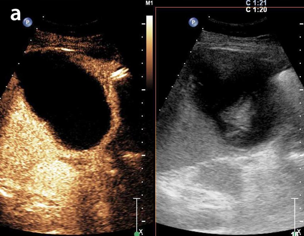 Case 8 Fig.: 8a- A 26-six year old woman with fever and right upper abdominal pain. Baseline ultrasound examination shows a cystic lesion with a hyperchoic area inside.