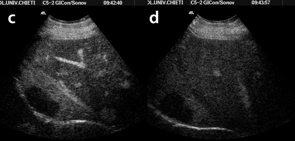 Fig.: 9c,9d- The lesion remains markedly hypoechoic during both portal (Fig.