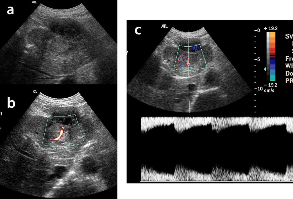 Fig.: 10a,b,c- An ultrasound routine examination of a patient with inhomogeneous hyperechoic lesion (Fig.10a).
