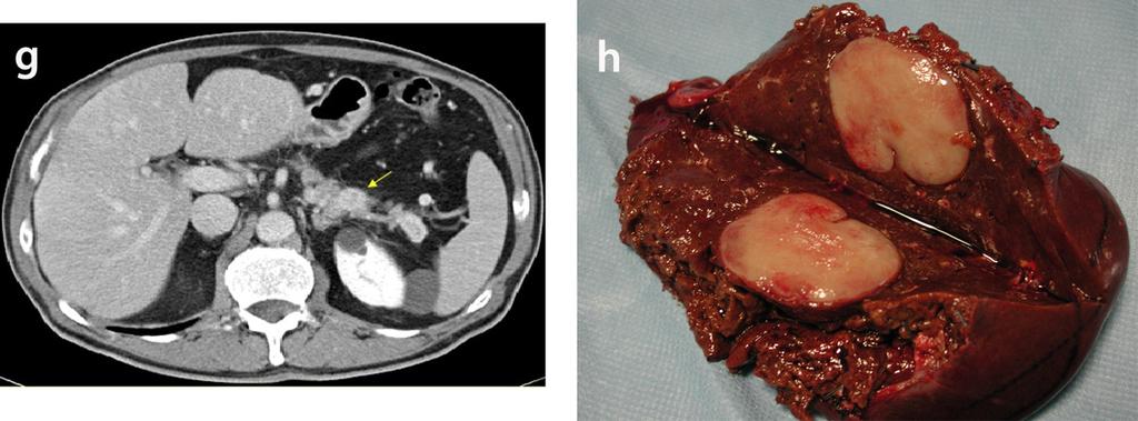Fig.: 10g,10h- The lesion resulted to be a metastasis from neuroendocrine tumor of