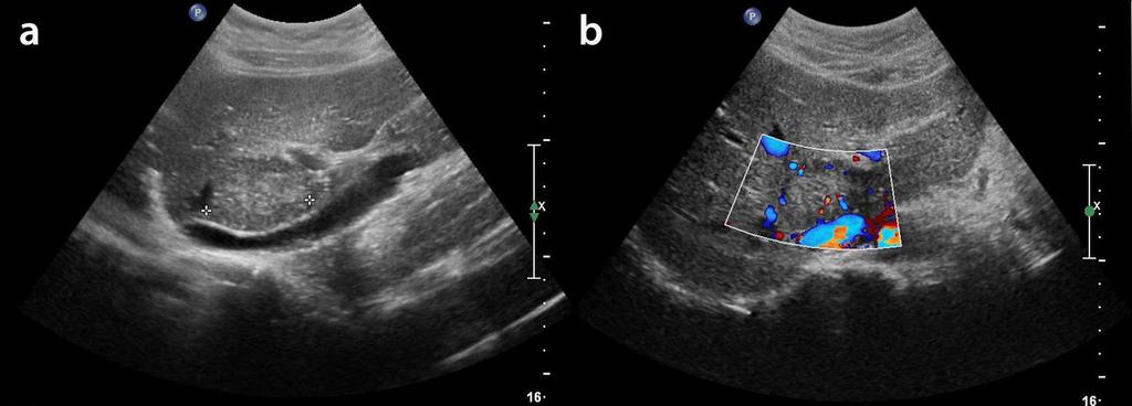 Fig.: 1b,1c- At CEUS examination the lesion shows a peripheral globular pattern during the arterial phase (Fig.