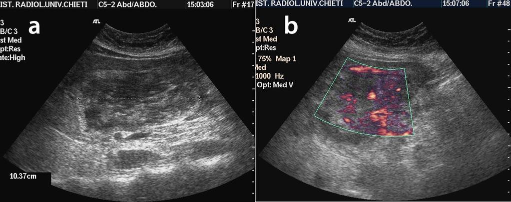 Fig.: 5a,5b- At baseline US examination a huge, inhomogeneous liver lesion with a hyperechoic wall was well depicted (Fig.5a).