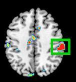 Gut:brain axis n=36 MRI 4 weeks Live yoghurt (B.