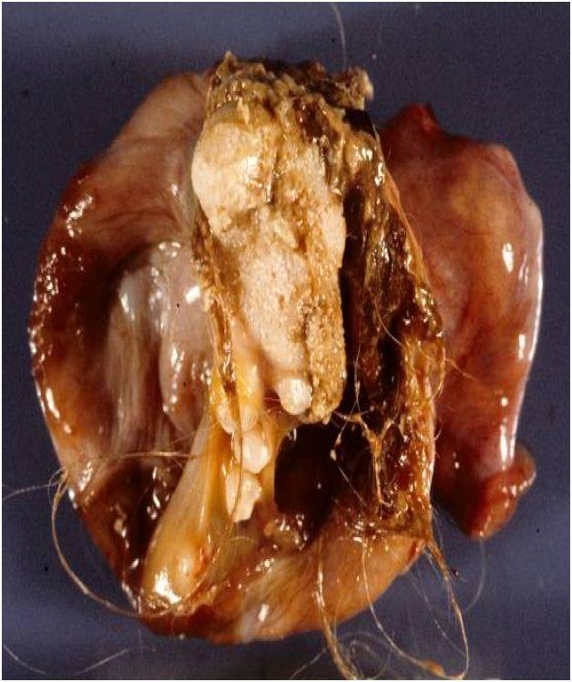 Teratoma is made up of several different types of tissue that are not normally found at that site.