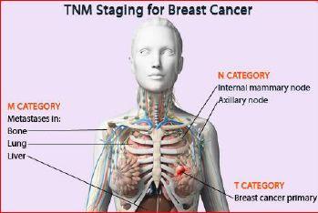 stage III= direct invasion with no metastasis stage IV= metastasis 2-TNM: T1, No, Mo T (description of