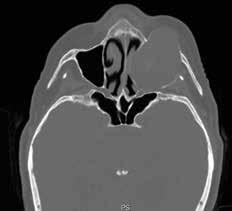 The CT scn illustrted homogeneous cystic lesion tht expnds superiorly in the left mxillry ntrum nd protrudes medilly into the middle nd inferior turintes, cusing prtil