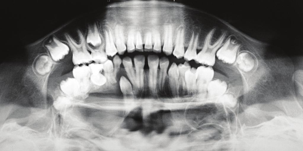 2 Case Reports in Dentistry Figure 1: Initial panoramic radiography: retention of the upper right second premolar and upper right canine with increased pericoronal space, vertical impaction, and root