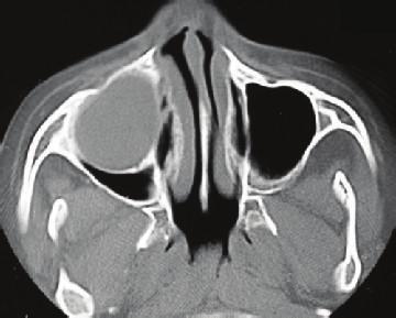 Case Reports in Dentistry 3 (a) (b) Figure 2: CT axial images showing opacity of the right maxillary sinus in the diagnostic phase (a); maxillary sinus cleared after 3 months of treatment (b).
