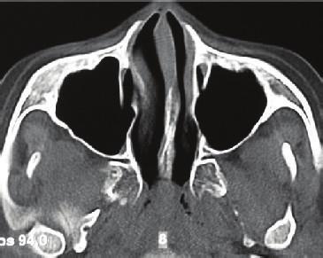 Figure 4: Final panoramic radiography: upper right canine positionedinthedentalarchshowingreducedrootlength.