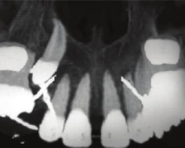 recommend extraction of palatal canines severely impacted in height, when they are vertically positioned above the apices of the incisors [20].